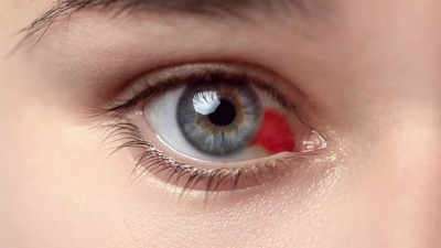 Human contact fuels deadly Bleeding Eye Disease outbreak: What we need to know